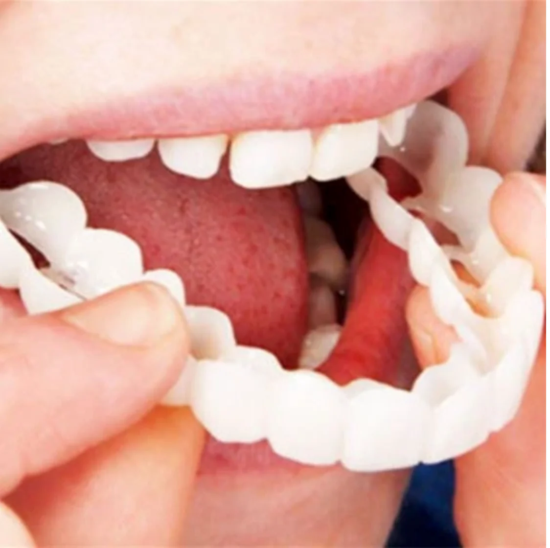 HappySmile Facetset | Herbruikbare boven- en onderfacetten voor een stralende lach